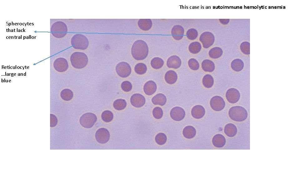 This case is an autoimmune hemolytic anemia Spherocytes that lack central pallor Reticulocyte …large