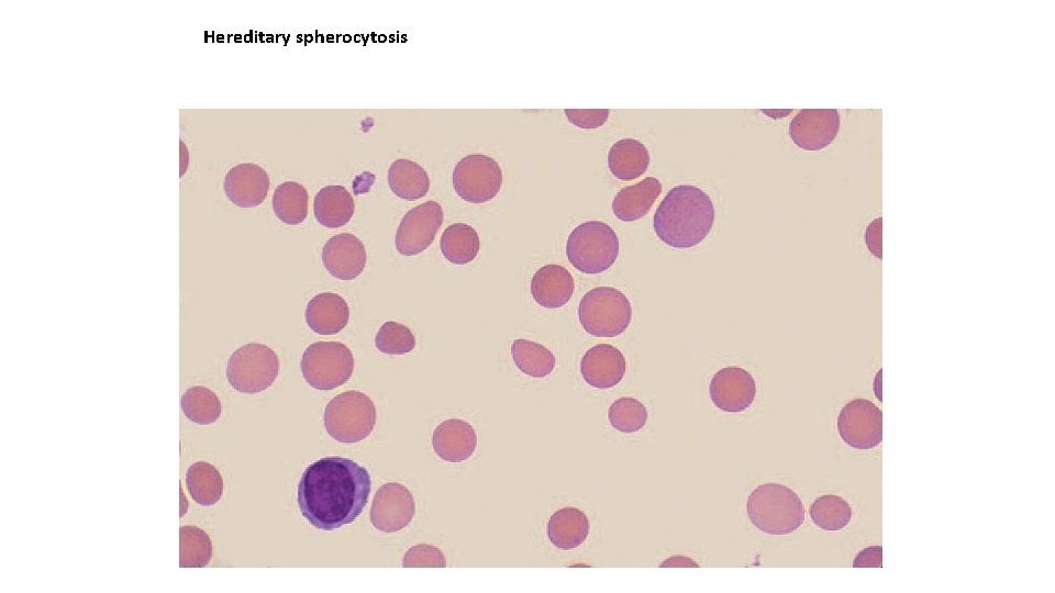 Hereditary spherocytosis 
