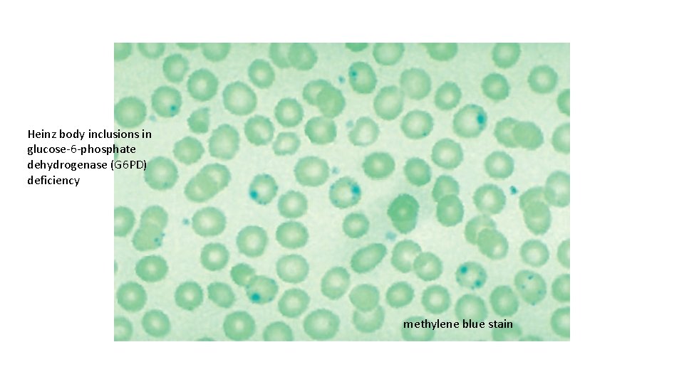 Heinz body inclusions in glucose-6 -phosphate dehydrogenase (G 6 PD) deficiency methylene blue stain