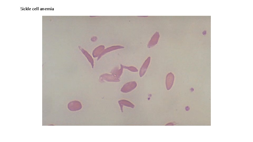 Sickle cell anemia 