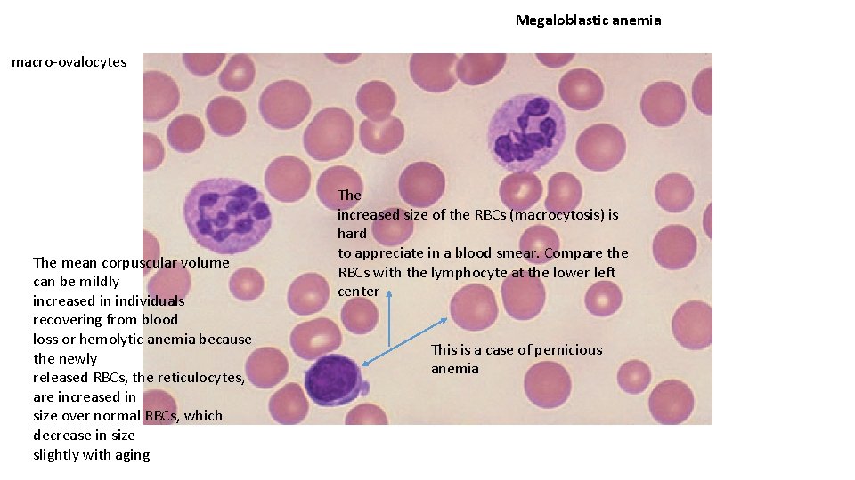 Megaloblastic anemia macro-ovalocytes The mean corpuscular volume can be mildly increased in individuals recovering
