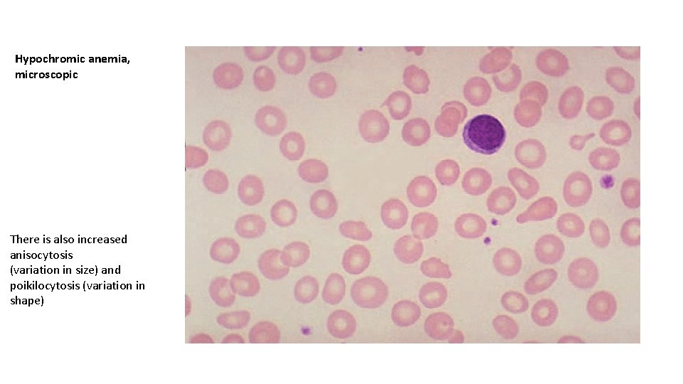 Hypochromic anemia, microscopic There is also increased anisocytosis (variation in size) and poikilocytosis (variation