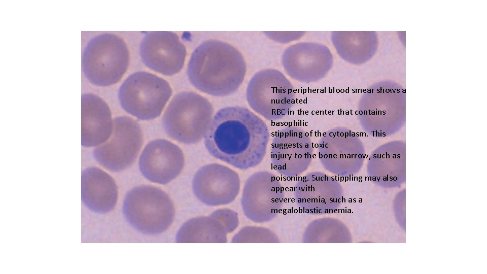 This peripheral blood smear shows a nucleated RBC in the center that contains basophilic
