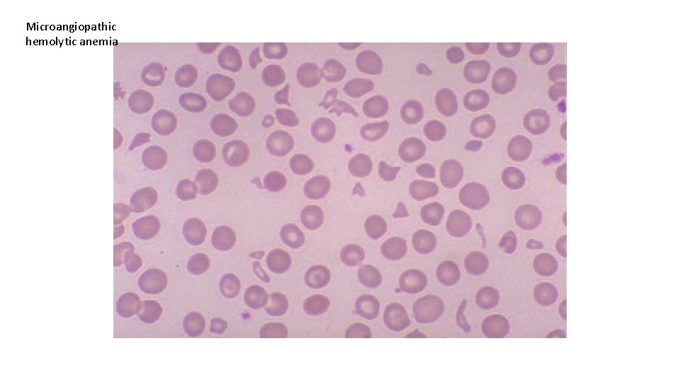 Microangiopathic hemolytic anemia 