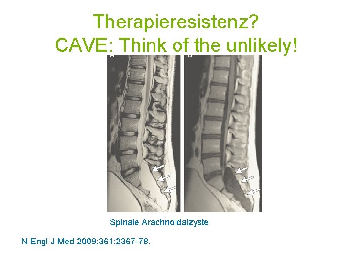 Therapieresistenz? CAVE: Think of the unlikely! Spinale Arachnoidalzyste N Engl J Med 2009; 361: