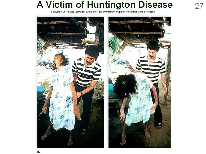 A Victim of Huntington Disease 27 