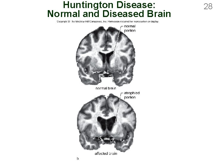 Huntington Disease: Normal and Diseased Brain 28 