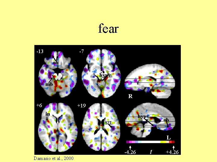 fear -13 -7 ob hypv mb R +6 +19 in hypv ob SII L