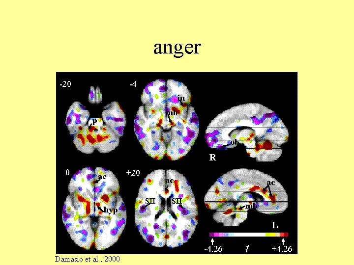 anger -20 -4 in mb p ob R 0 ac hyp +20 ac SII