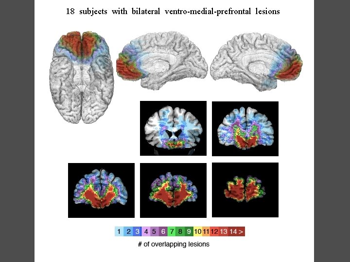 18 subjects with bilateral ventro-medial-prefrontal lesions 