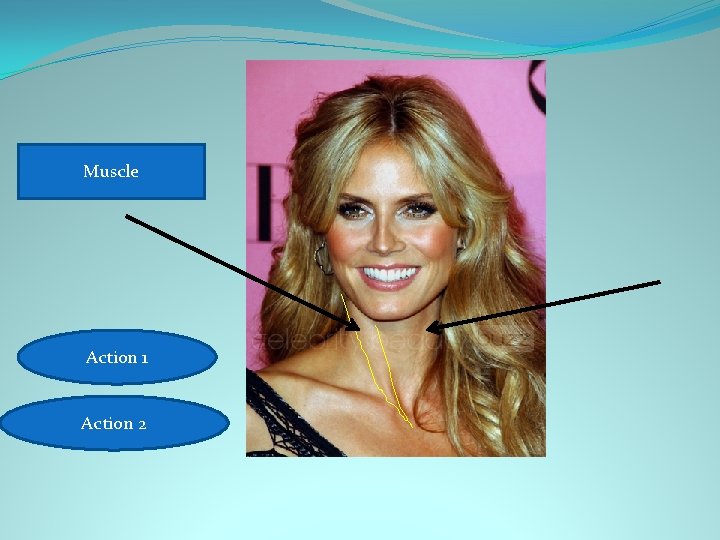 Sternocleidomastoid Muscle 1. Rotates head 1(alone) Action 2. Flexes. Action neck (together) 2 