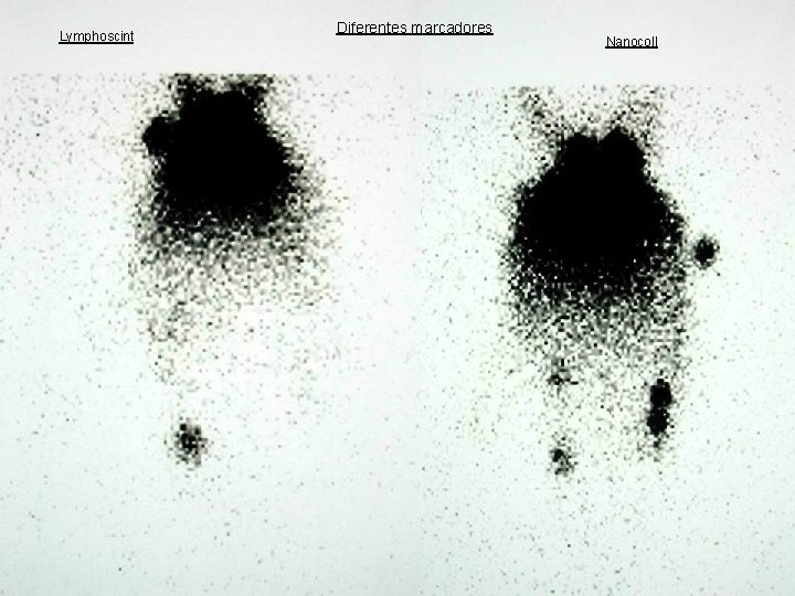 Lymphoscint Diferentes marcadores 1. 5 No Extirpado Diferentes marcadores Nanocoll Comité Melanoma HUVA 