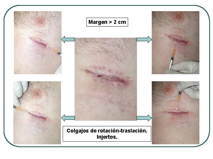 Margen > 2 cm Colgajos de rotación-traslación. Injertos. 