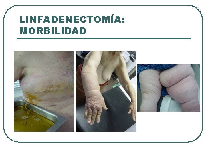 LINFADENECTOMÍA: MORBILIDAD 
