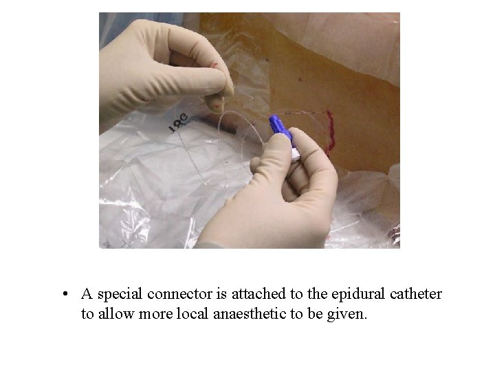  • A special connector is attached to the epidural catheter to allow more