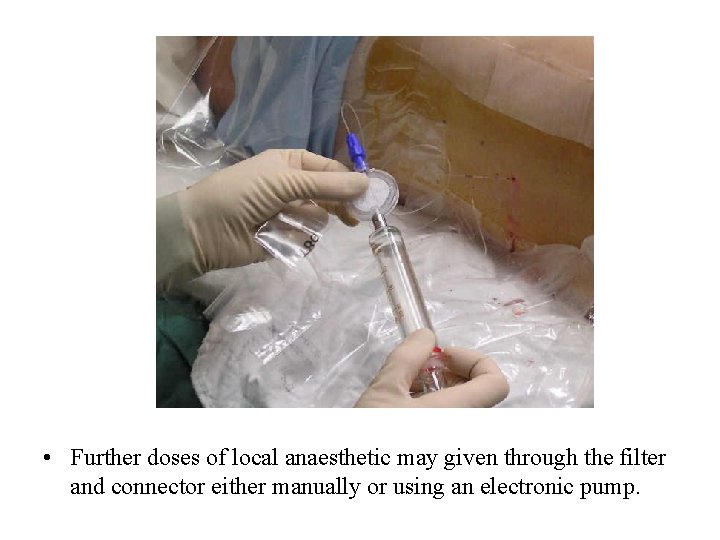  • Further doses of local anaesthetic may given through the filter and connector