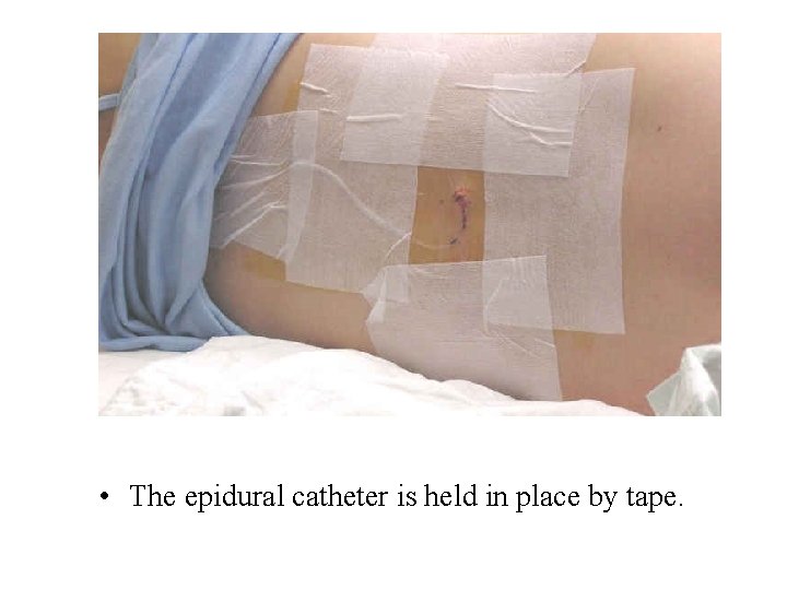  • The epidural catheter is held in place by tape. 