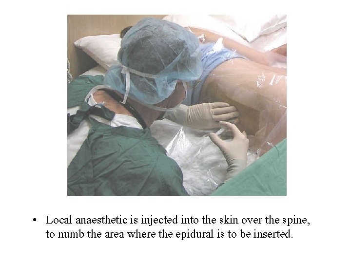  • Local anaesthetic is injected into the skin over the spine, to numb