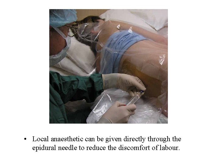  • Local anaesthetic can be given directly through the epidural needle to reduce