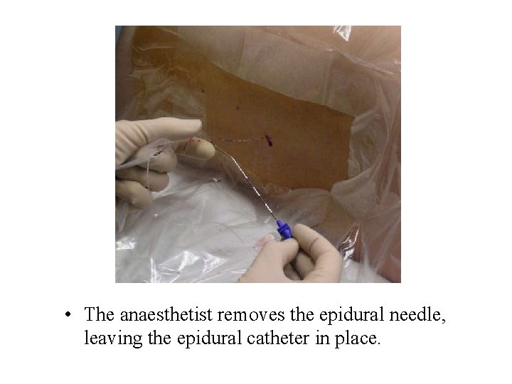  • The anaesthetist removes the epidural needle, leaving the epidural catheter in place.