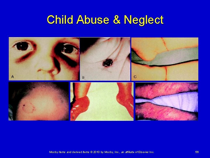 Child Abuse & Neglect Mosby items and derived items © 2010 by Mosby, Inc.