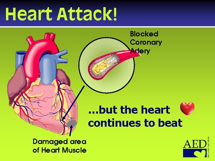 Heart Attack! Blocked Coronary Artery I Damaged area of Heart Muscle …but the heart