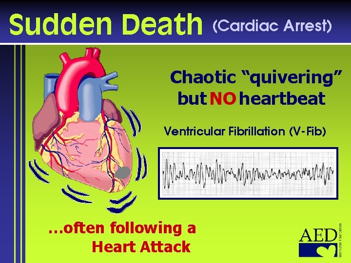Sudden Death (Cardiac Arrest) Chaotic “quivering” but NO heartbeat Ventricular Fibrillation (V-Fib) …often following