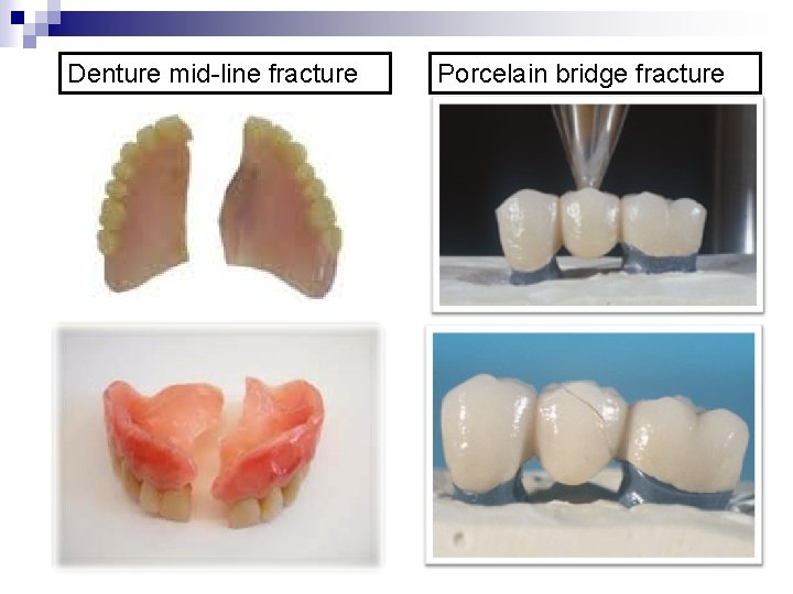 Denture mid-line fracture Porcelain bridge fracture 