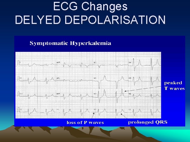 ECG Changes DELYED DEPOLARISATION 