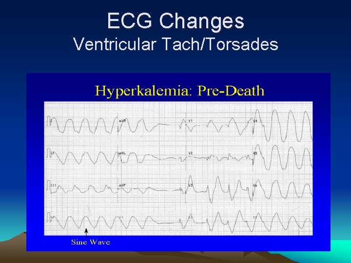 ECG Changes Ventricular Tach/Torsades 