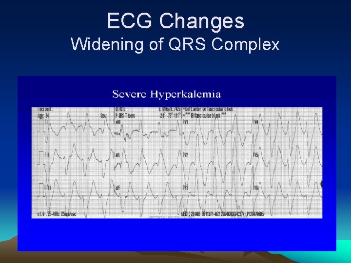 ECG Changes Widening of QRS Complex 