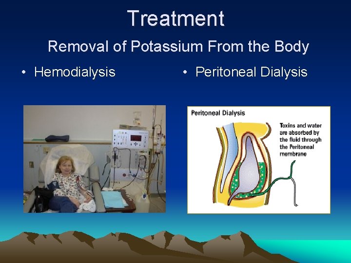 Treatment Removal of Potassium From the Body • Hemodialysis • Peritoneal Dialysis 