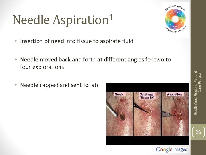 Needle Aspiration 1 • Insertion of need into tissue to aspirate fluid • Needle