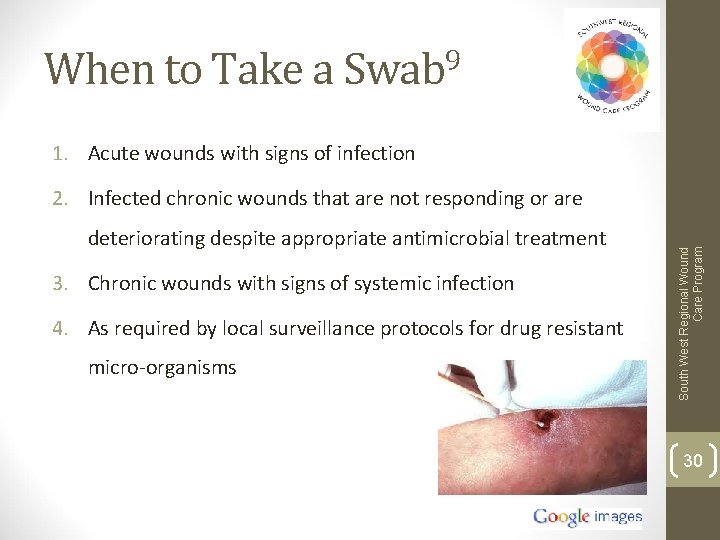 When to Take a Swab 9 1. Acute wounds with signs of infection deteriorating