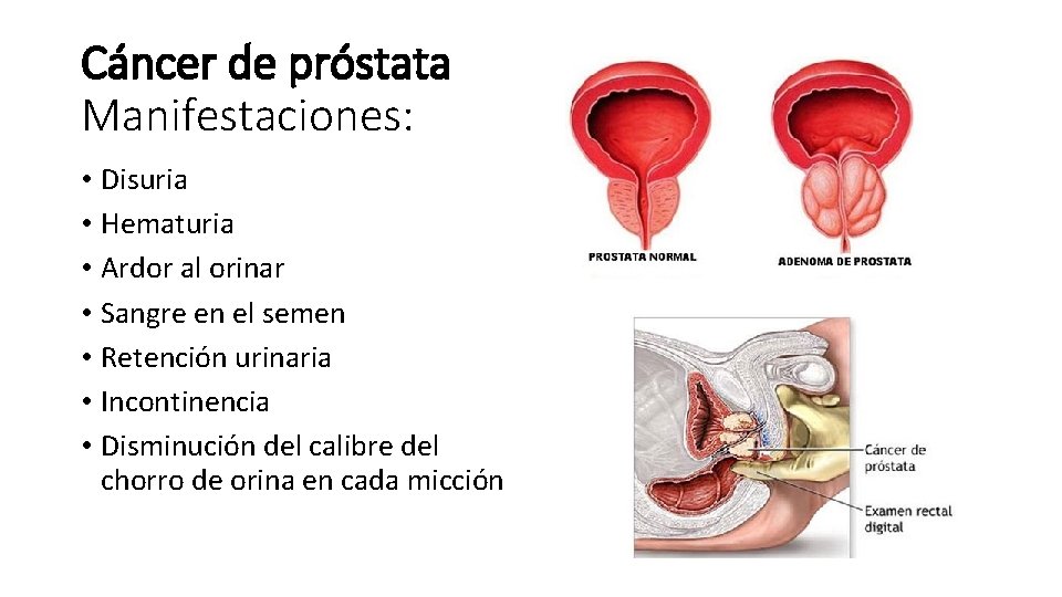 Cáncer de próstata Manifestaciones: • Disuria • Hematuria • Ardor al orinar • Sangre