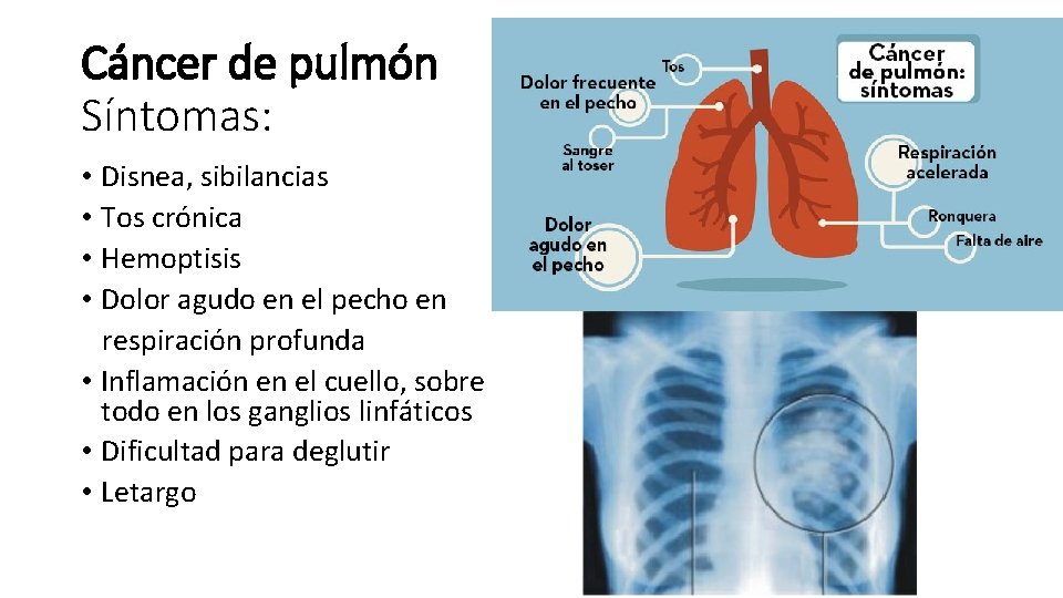 Cáncer de pulmón Síntomas: • Disnea, sibilancias • Tos crónica • Hemoptisis • Dolor