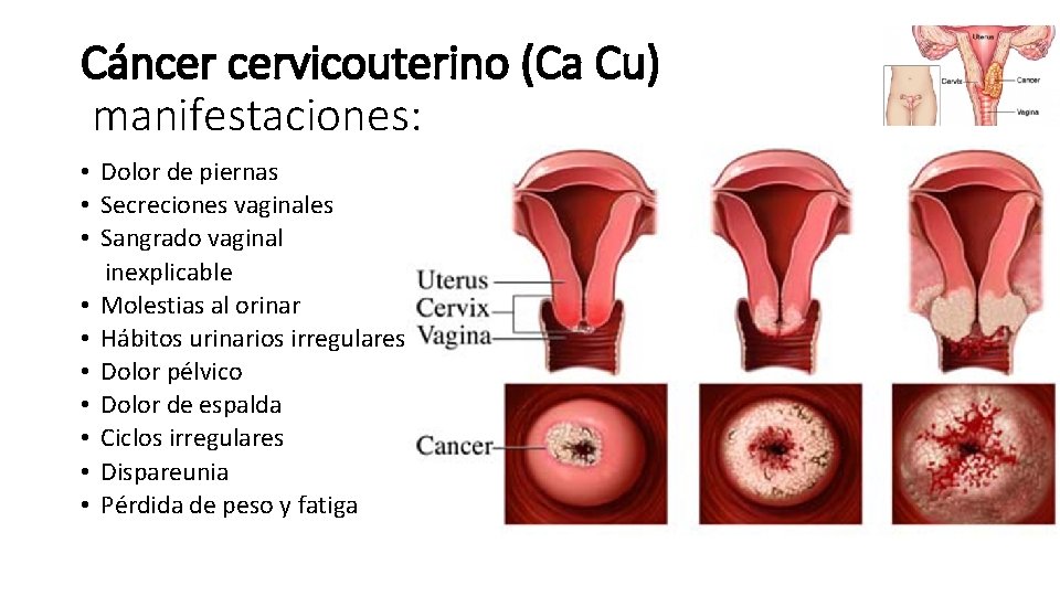 Cáncer cervicouterino (Ca Cu) manifestaciones: • Dolor de piernas • Secreciones vaginales • Sangrado