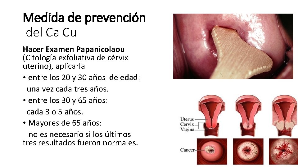 Medida de prevención del Ca Cu Hacer Examen Papanicolaou (Citología exfoliativa de cérvix uterino),