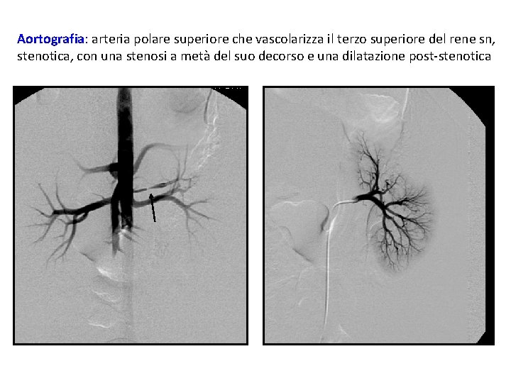 Aortografia: arteria polare superiore che vascolarizza il terzo superiore del rene sn, stenotica, con