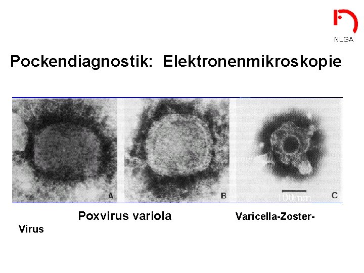 NLGA Pockendiagnostik: Elektronenmikroskopie Poxvirus variola Virus Varicella-Zoster- 