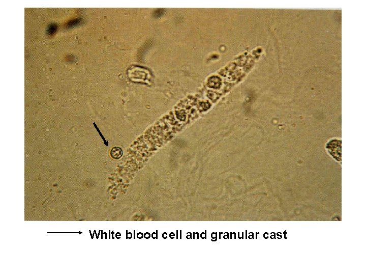 White blood cell and granular cast 