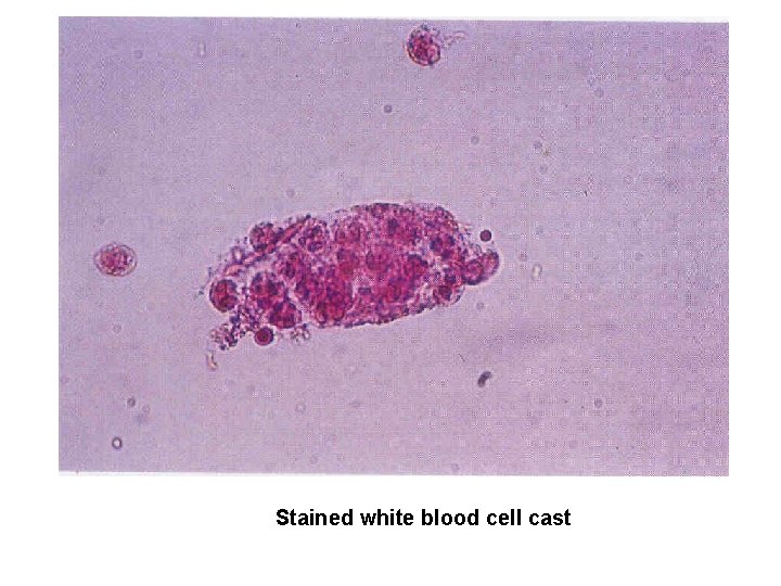 Stained white blood cell cast 