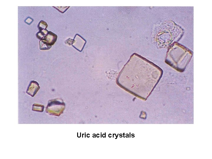 Uric acid crystals 