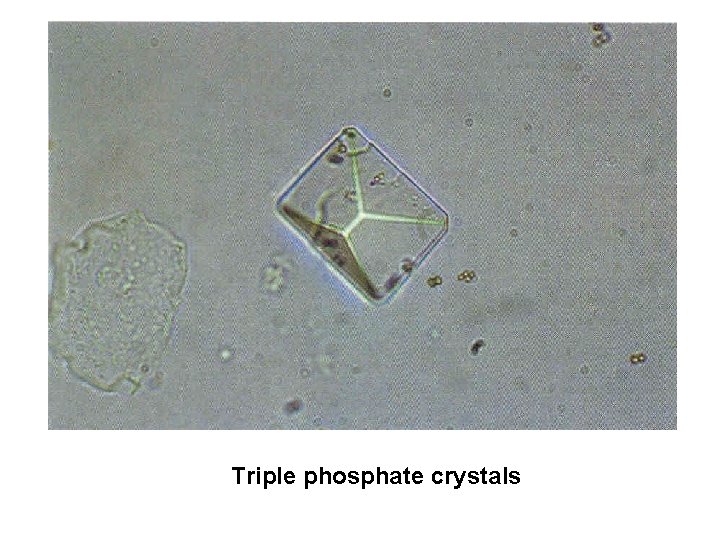 Triple phosphate crystals 