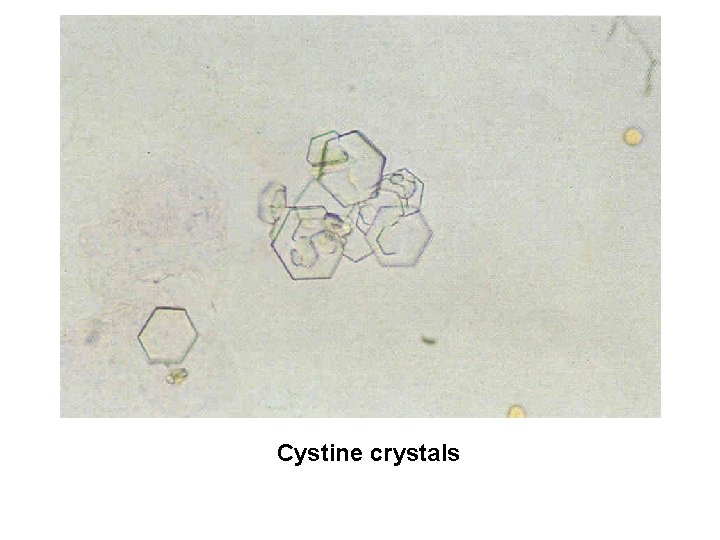 Cystine crystals 