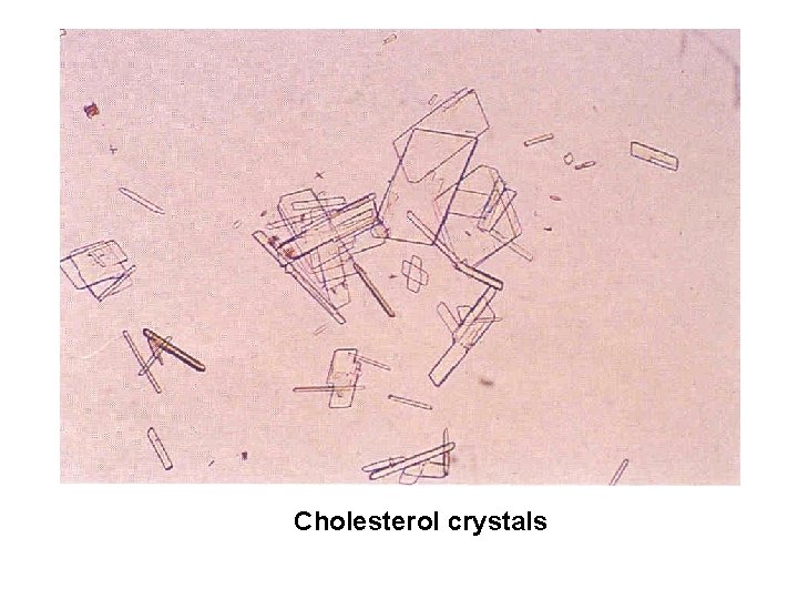 Cholesterol crystals 