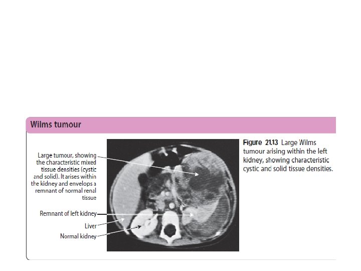 Wilms tumour (nephroblastoma) originates from embryonal renal tissue and is the commonest renal tumour