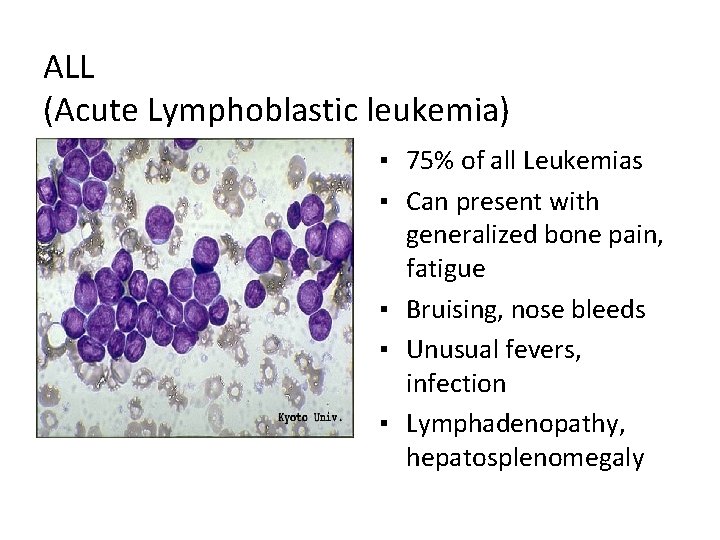 ALL (Acute Lymphoblastic leukemia) ▪ 75% of all Leukemias ▪ Can present with generalized