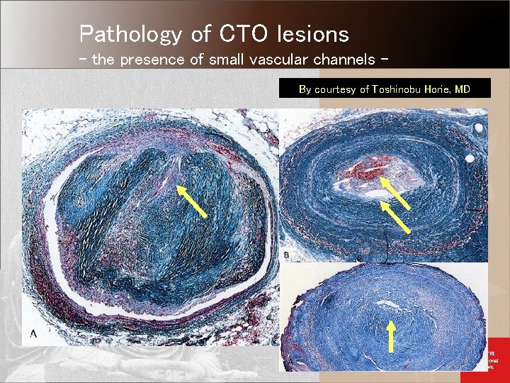 Pathology of CTO lesions - the presence of small vascular channels By courtesy of