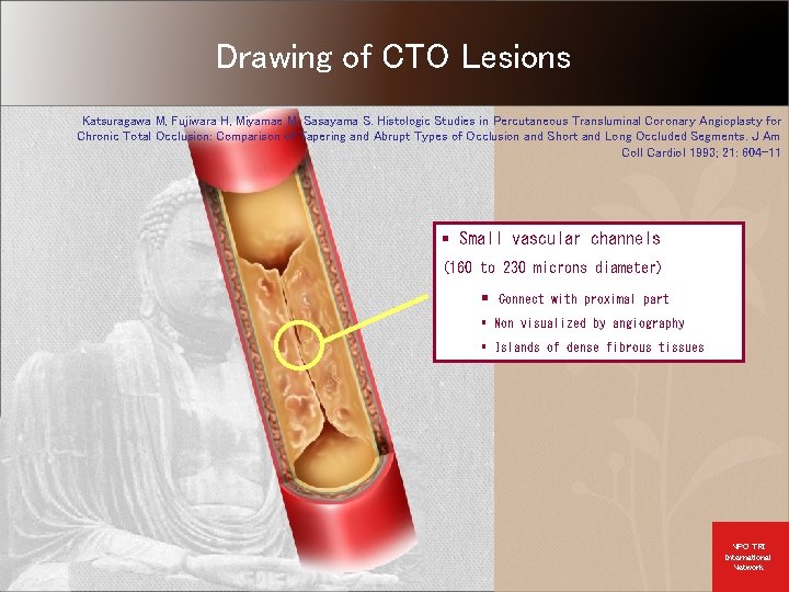Drawing of CTO Lesions Katsuragawa M, Fujiwara H, Miyamae M, Sasayama S. Histologic Studies